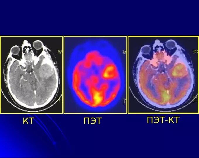 Позитронно-эмиссионная томография опухоли. Позитронно-эмиссионная томография сердца. Лимфома головного мозга ПЭТ кт. Позитрон-эмиссионная  томография: ПЭТ. Пэт кт или кт что лучше