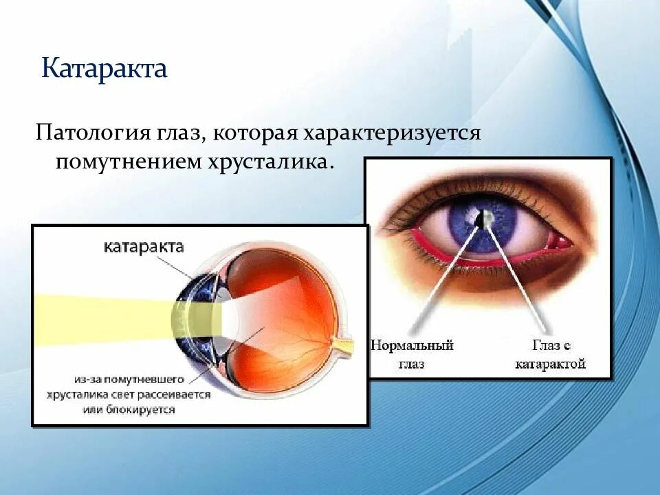 Заболевания глаз биология 8 класс. Заболевание глаз катаракта. Презентация заболевания глаз. Заболевания глаз доклад.