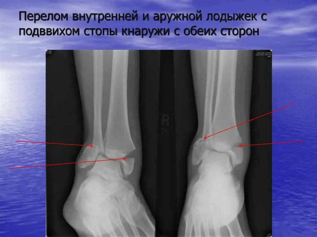 Угол голеностопного сустава. Чрезсиндесмозный перелом лодыжки. Подвывих стопы кнаружи рентген. Пронационный перелом лодыжки. Подвывих голеностопного сустава рентген.