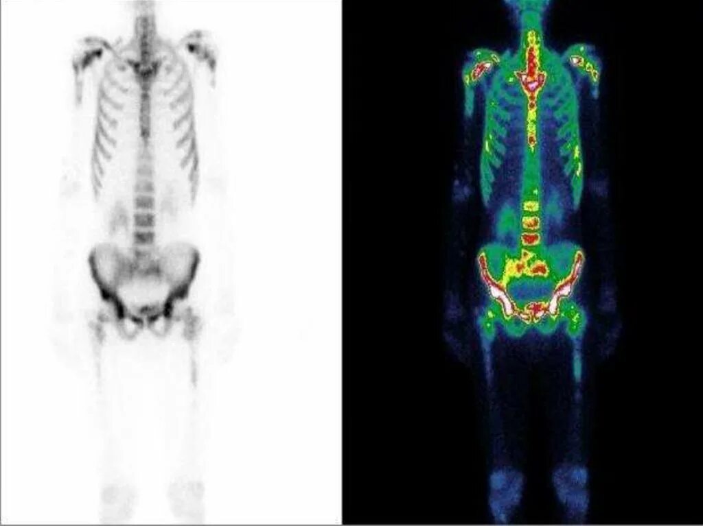 Метастатическое поражение кости. Статическая сцинтиграфия скелета. Сцинтиграфия костей скелета (остеосцинтиграфия). Радионуклидная диагностика скелета. Сцинтиграфия метастазы.