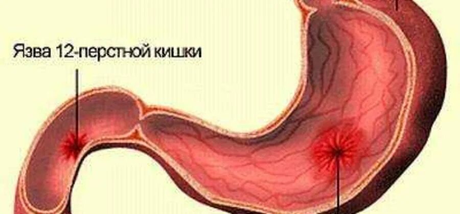 Болезни двенадцатиперстной кишки у ребенка. Язвенная болезнь желудка и 12 перстной. Язвенная болезнь желудка и 12 кишки. Язвенная болезнь желудка и 12 перстной кишки. Язвенная болезнь 12 п кишки.