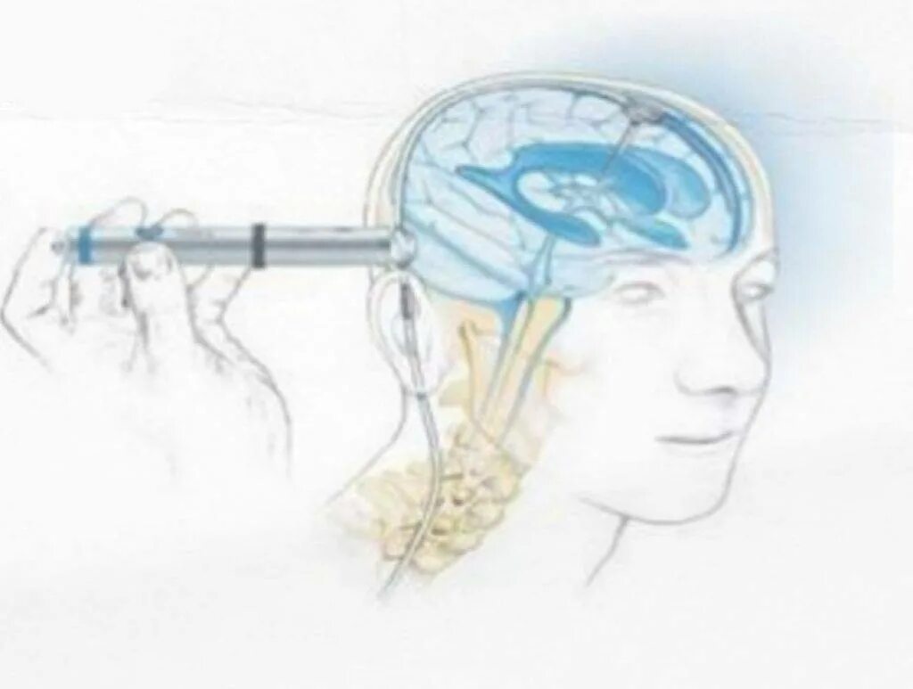 Шунт головного мозга. Гидроцефалия головного шунт. Шунт головной мозг ликвора. Шунтирование мозга гидроцефалия головного мозга. Операция шунтирование головного мозга у ребенка.