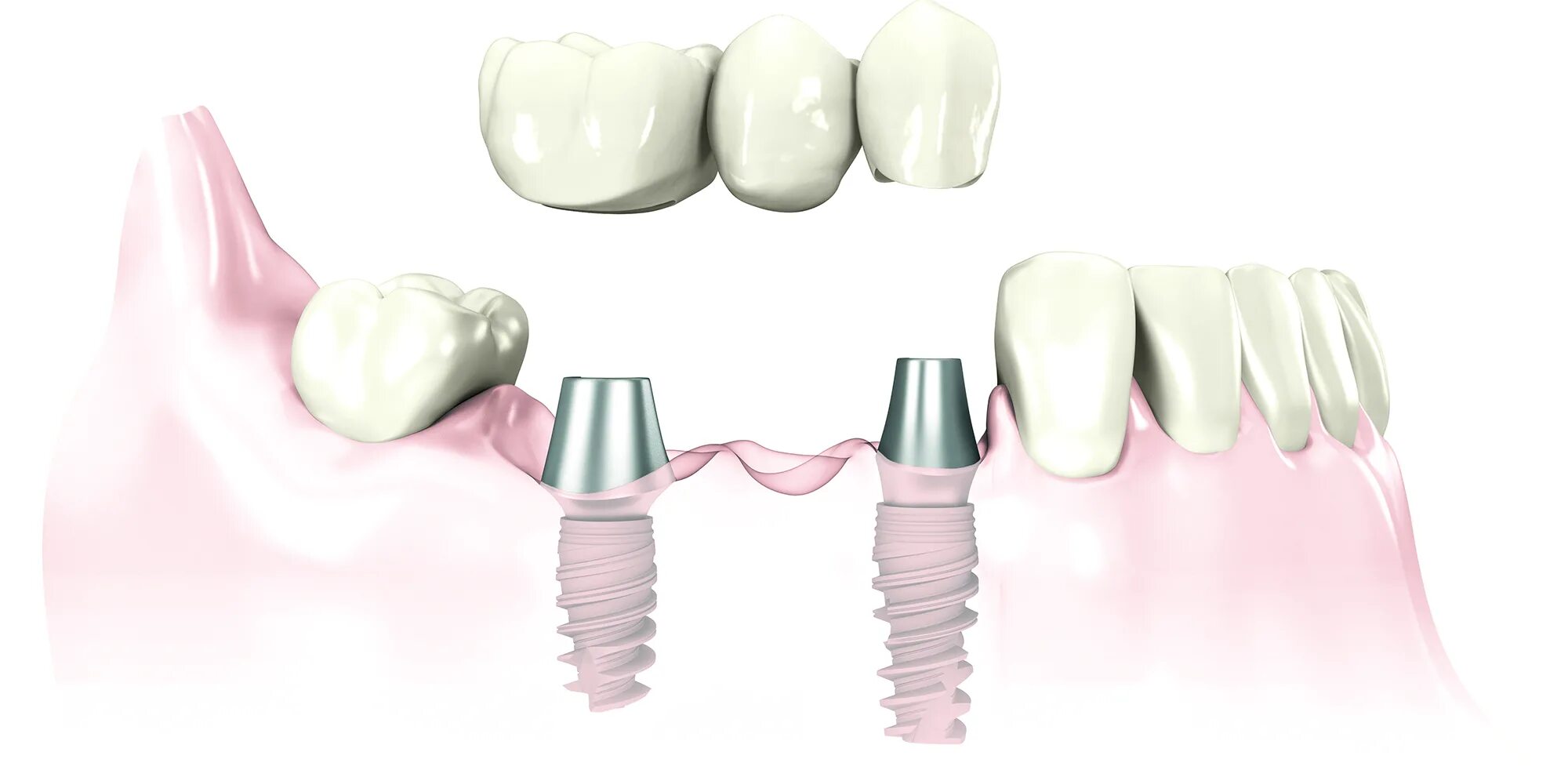 Имплант зуба Nobel Biocare. Мостовидный протез на имплантах на 2 зуба. Мостовидный протез на 4 имплантах. Имплант зуба Osstem.