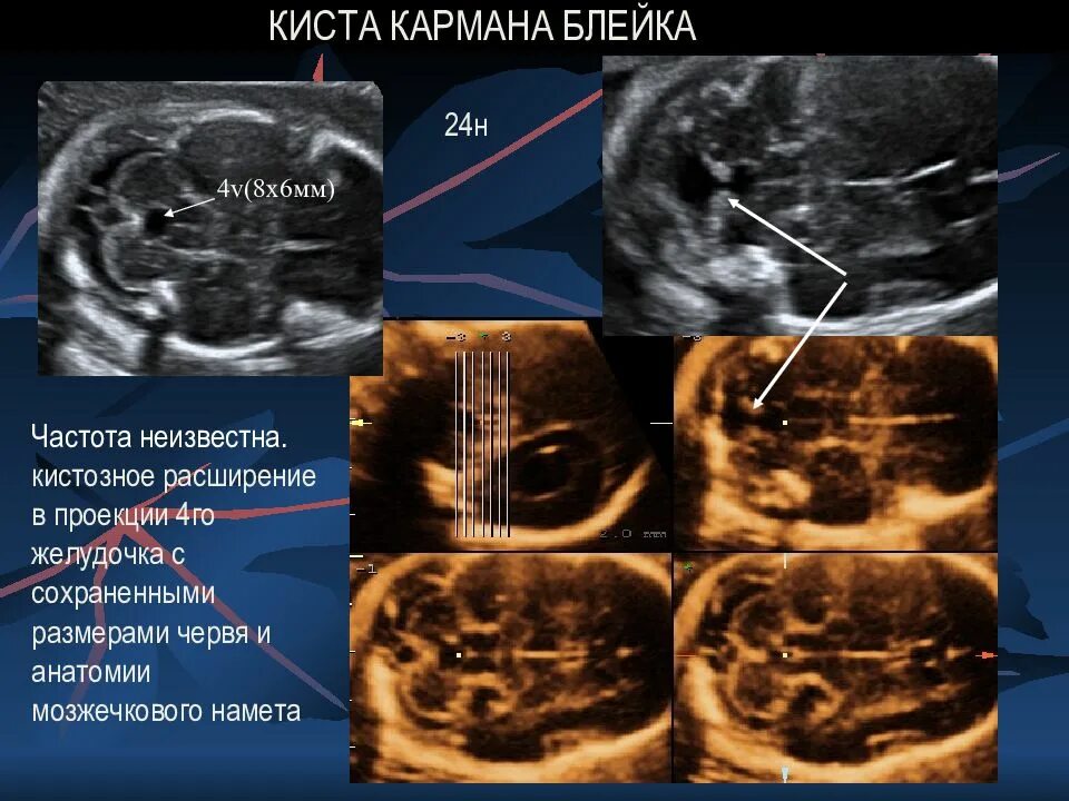 Гипоплазия червя. Киста кармана Блейка УЗИ. Персистирующая киста кармана Блейка. Киста кармана Блейка у плода на УЗИ. Киста кармана Блейка задней черепной ямки.