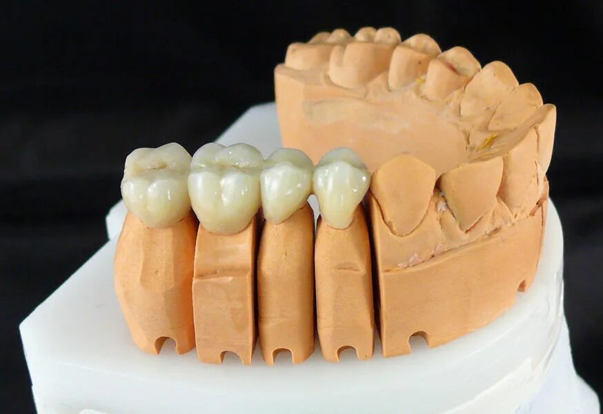 кермет металлокерамика. изготовление металлокерамической коронки зуба. безметалловая керамика диоксид циркония. керамометалическая коронка. метало керамич коронка.