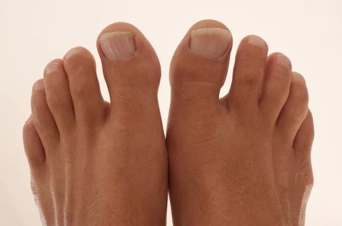 Вальгусный корректор вальгус стоп. Косточка халюс вальгус. Вальгусная деформация косточки. Деформация hallux valgus вальгусная. Косточки на больших пальцах.