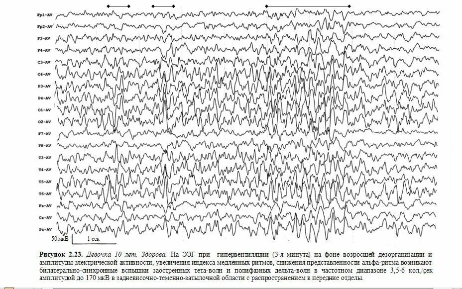 Ээг 3 лет. Дельта активность на ЭЭГ У взрослых. ЭЭГ волны характеристики. Показатели сна на ЭЭГ. Возрастные нормы Альфа ритма на ЭЭГ.