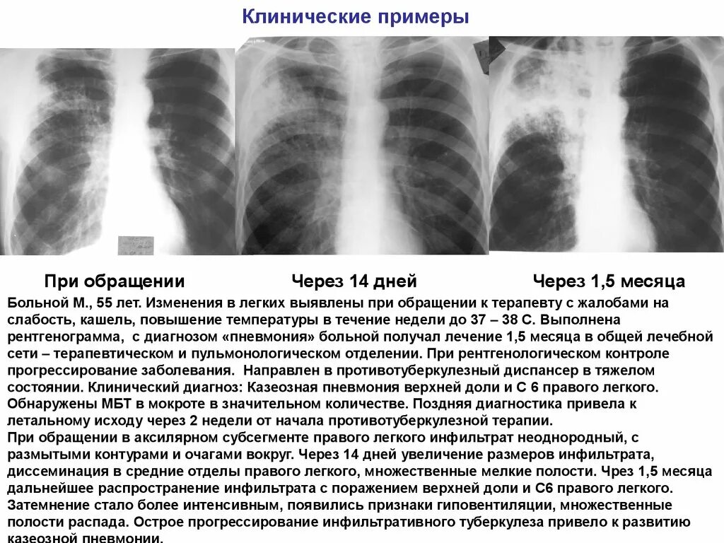 Изменение в верхнем легком. Инфильтративный туберкулез Лобит рентген. Очагово-инфильтративный туберкулез рентген. Очаговый туберкулез верхней доли правого легкого в фазе инфильтрации. Описание рентгенограммы инфильтративного туберкулеза.