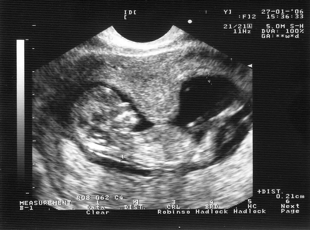 Гипертонус матки при беременности 2 триместр УЗИ. Тонус матки при беременности 1 триместр УЗИ. Гипертонус стенки матки при беременности 12 недель. Гипертонус матки на УЗИ при беременности. При беременности ощущается матка