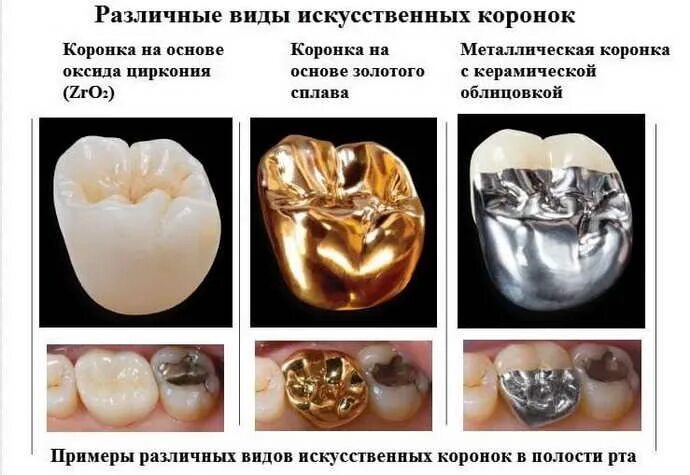 Коронка штампованная стальная восстановительная. Стандартные металлические коронки 3м. Металлические зубные коронки.