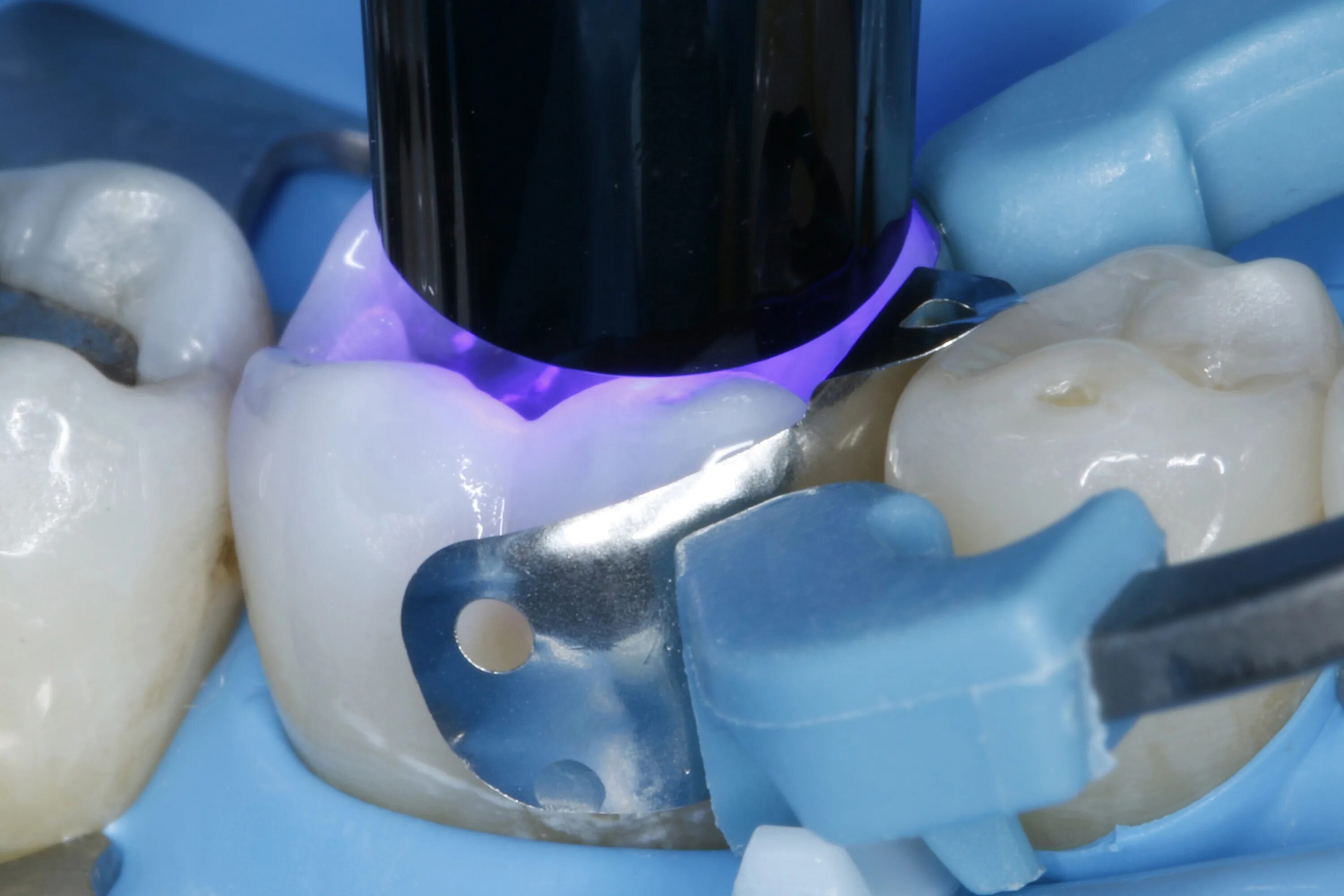 Материал для реставрации зубов. Пломбы фотоотверждаемые композиты. Пломба светоотверждаемая Charisma (1. Световая фотополимерная пломба. Химический композит пломба.
