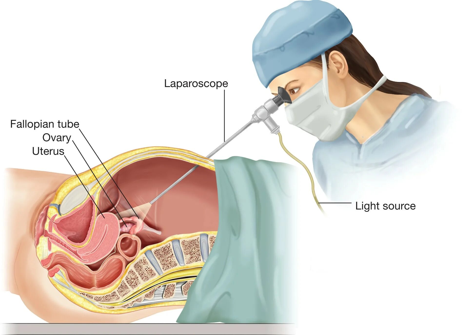Лапароскопия дермоидной кисты. Лапароскопия в гинекологии. Лапароскопическая операция в гинекологии. Лапароскопия всгинекологии.