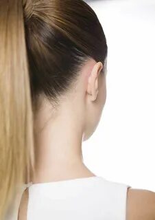 Protruding ears