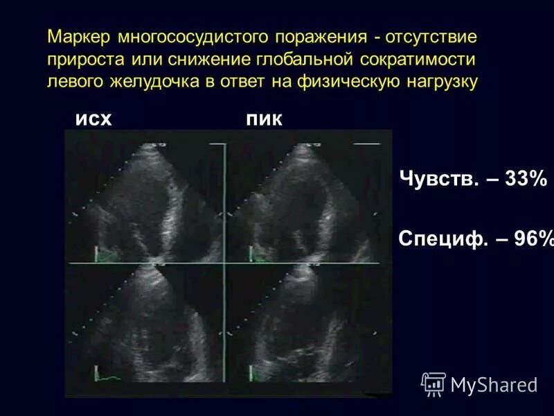 Глобальная сократимость левого. ЭХОКГ инфаркт миокарда. ЭХОКГ при инфаркте миокарда. Снижение глобальной сократимости миокарда левого желудочка. Снижение ФВ левого желудочка.