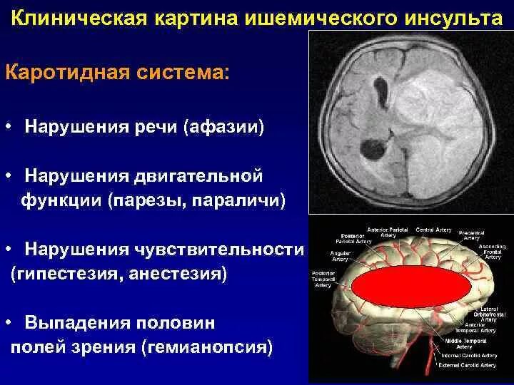 Клиника ишемического инсульта неврология. Ишемический инсульт в каротидном бассейне. Топический диагноз ишемического инсульта. Инсульт в каротидном бассейне.