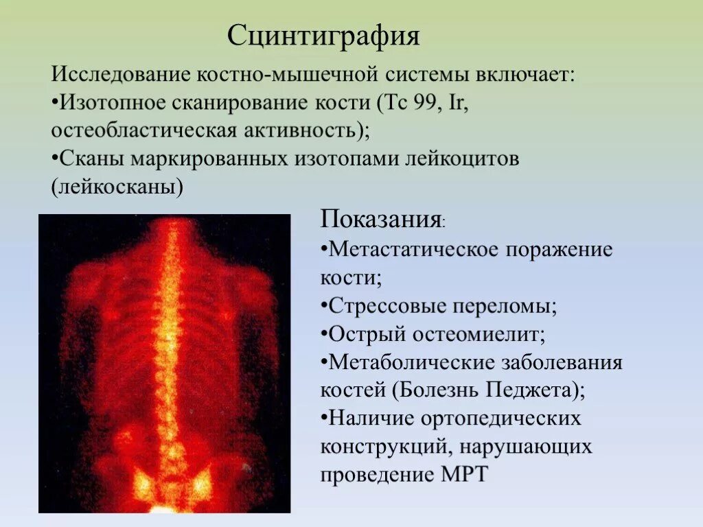 Сцинтиграфия костей процедура. Сцинтиграфия метод исследования. исследование костно мышечной системы. методы обследования костно-мышечной системы. методы исследования при заболеваниях костно-мышечной системы.