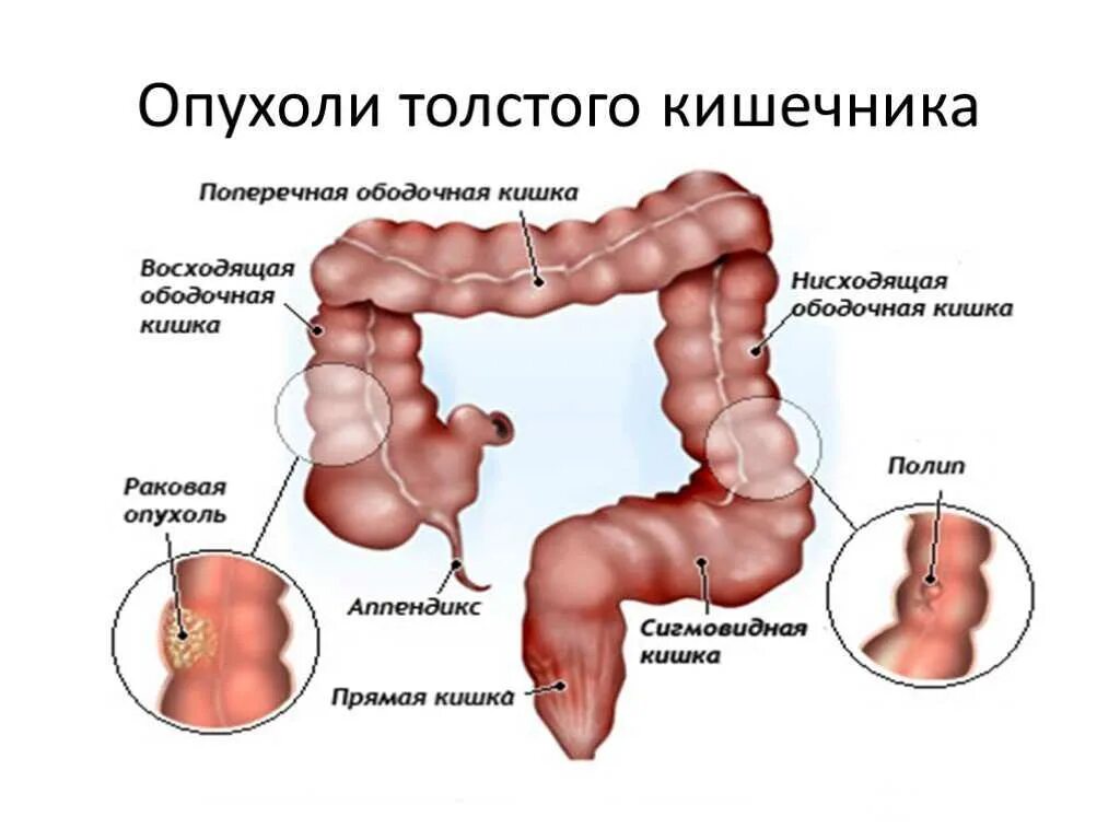 Неоплазия сигмовидной кишки. Неоплазия в ободочной кишке. Злокачественная опухоль ободочной кишки. Раковая опухоль толстой кишки.