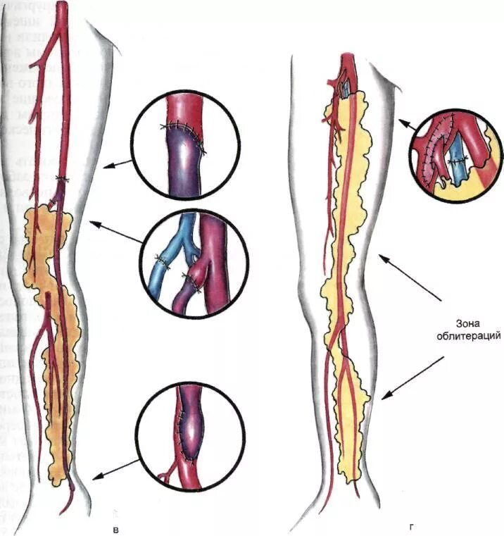 Реваскуляризационная остеотрепанация. Баллонная ангиопластика артерий голени. Трансплантация большого сальника на голень. Баллонная ангиопластика артерий нижних конечностей ход операции. Сосуды нижних конечностей врач