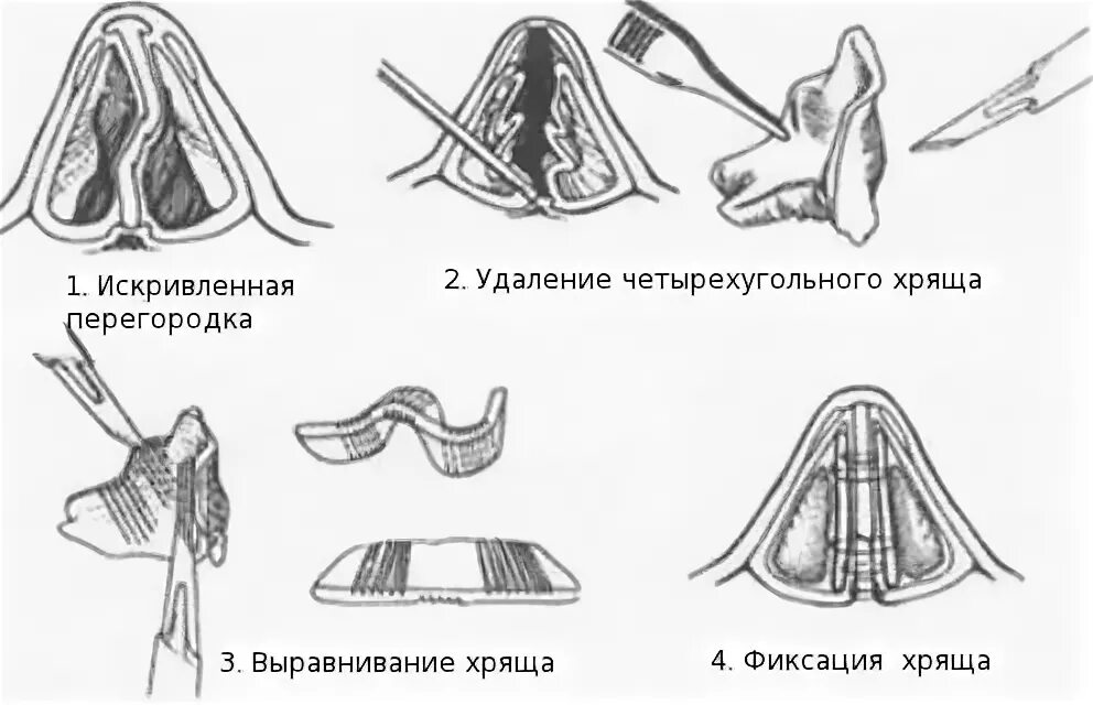 Подслизистая резекция перегородки носа. Септопластика носовой перегородки схема. Септопластика носовой перегородки ход операции. Анатомия искривлённой носовой перегородки. Операция по восстановлению перегородки