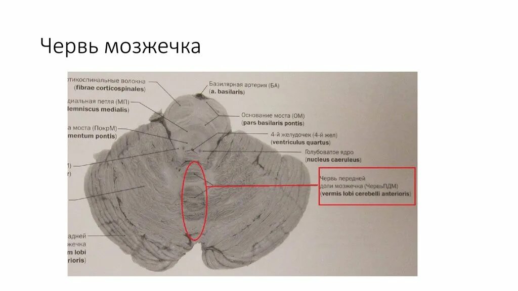 Гипоплазия червя. Червь в мозжечке головного мозга. Каудальный отдел червя мозжечка. Анатомия мозжечка мрт. Синдром поражения червя мозжечка.