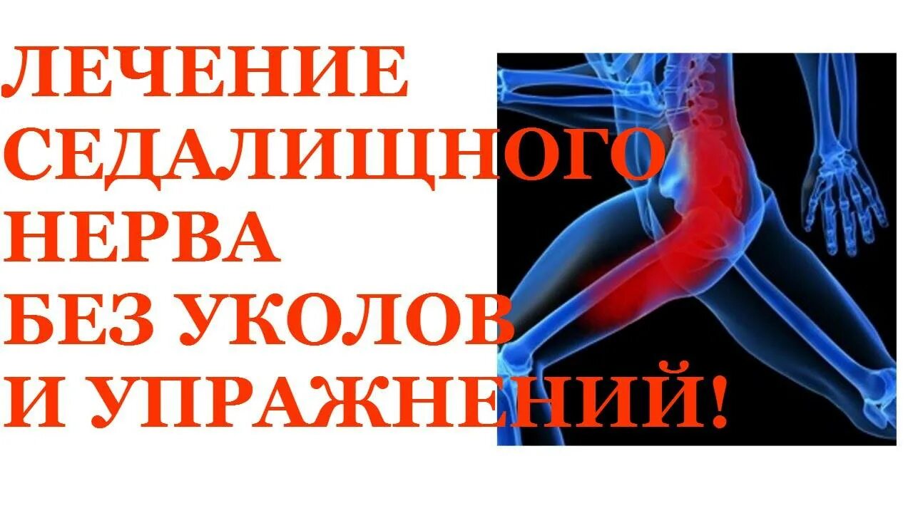 Защемление седалищного нерва. При защемлении седалищного нерва. Таблетки от ущемления седалищного нерва. Как вылечить седалищный нерв.