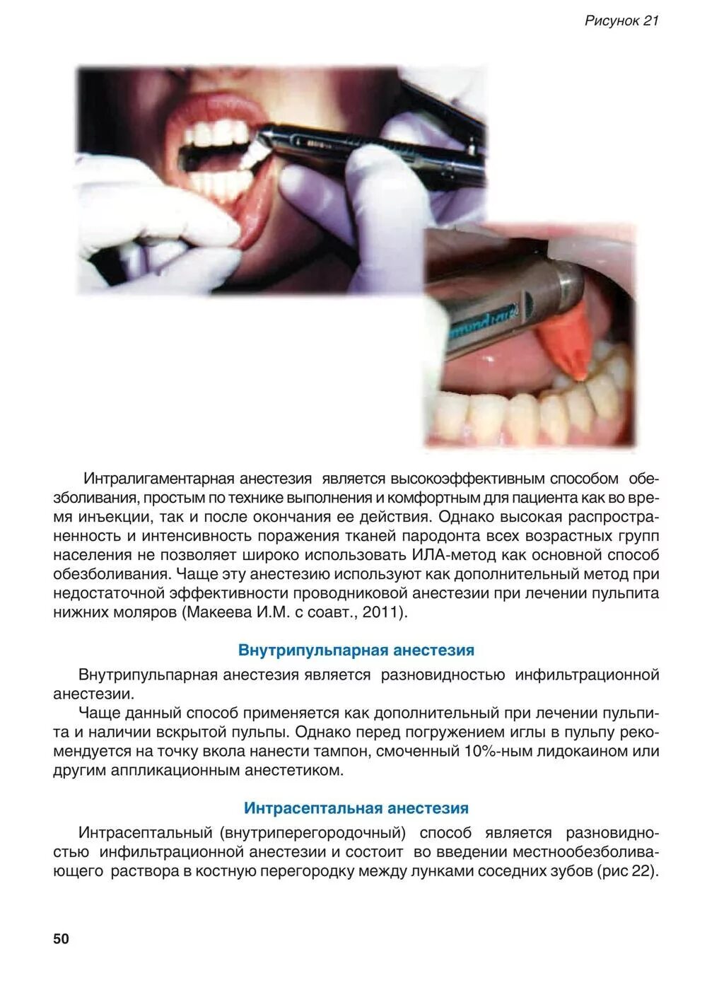 Обезболивание в стоматологии. Капельная анестезия в стоматологии. Как обезболить зуб без обезболивающих. Проводниковая анестезия нижней челюсти торусальная. Анестезия для детей в стоматологии.