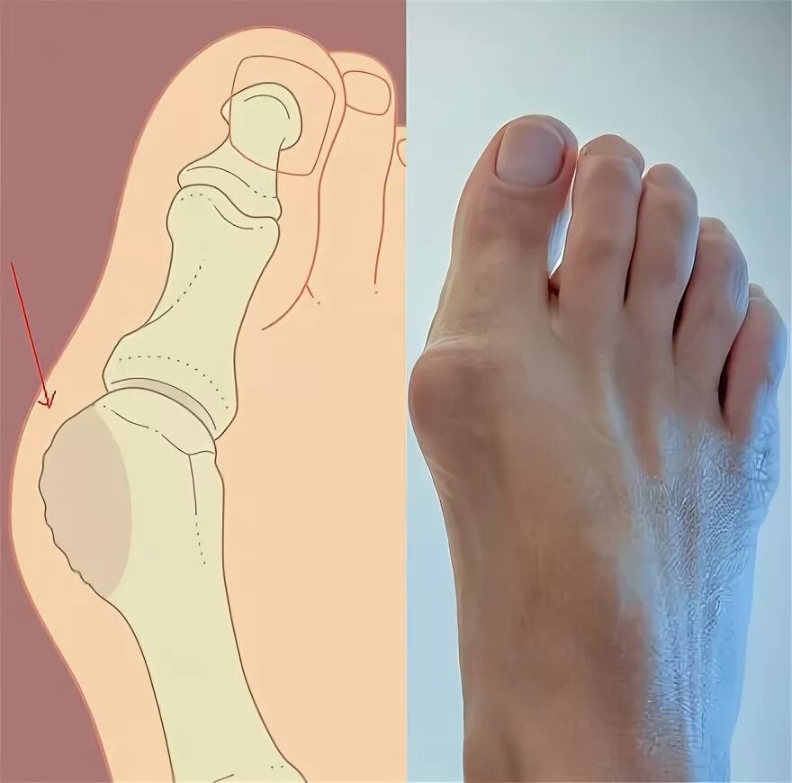 Hallux valgus 1 плюснефалангового сустава. Артроз больше го пальма тноги фото. Артрит большого пальца ноги. Остеоартроз большого пальца ноги. Остеоартроз большого пальца ноги.