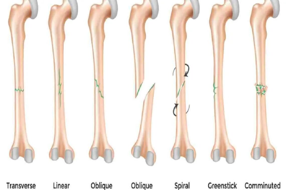 Перелом кости может быть каким