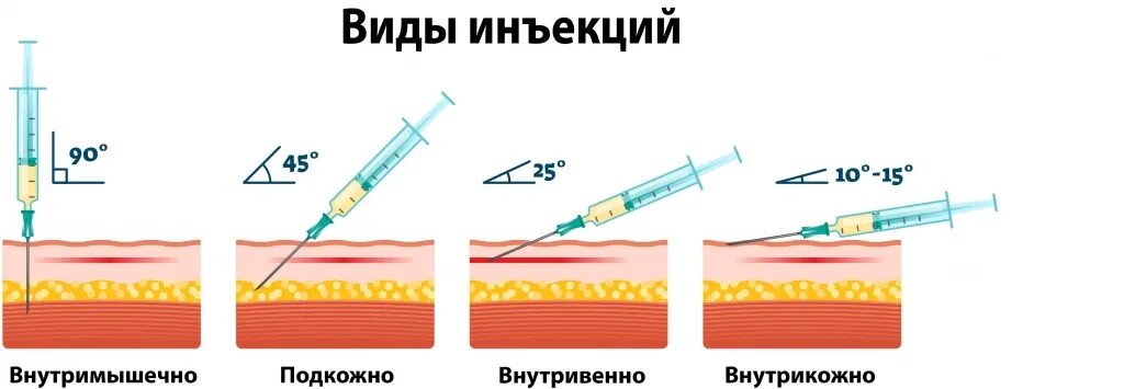 Градусы уколов. Схема внутримышечных инъекций масляных растворов. Укол 2 мл внутримышечно. Глубина введения внутримышечной инъекции. Инъекция внутримышечно в ягодицу алгоритм.