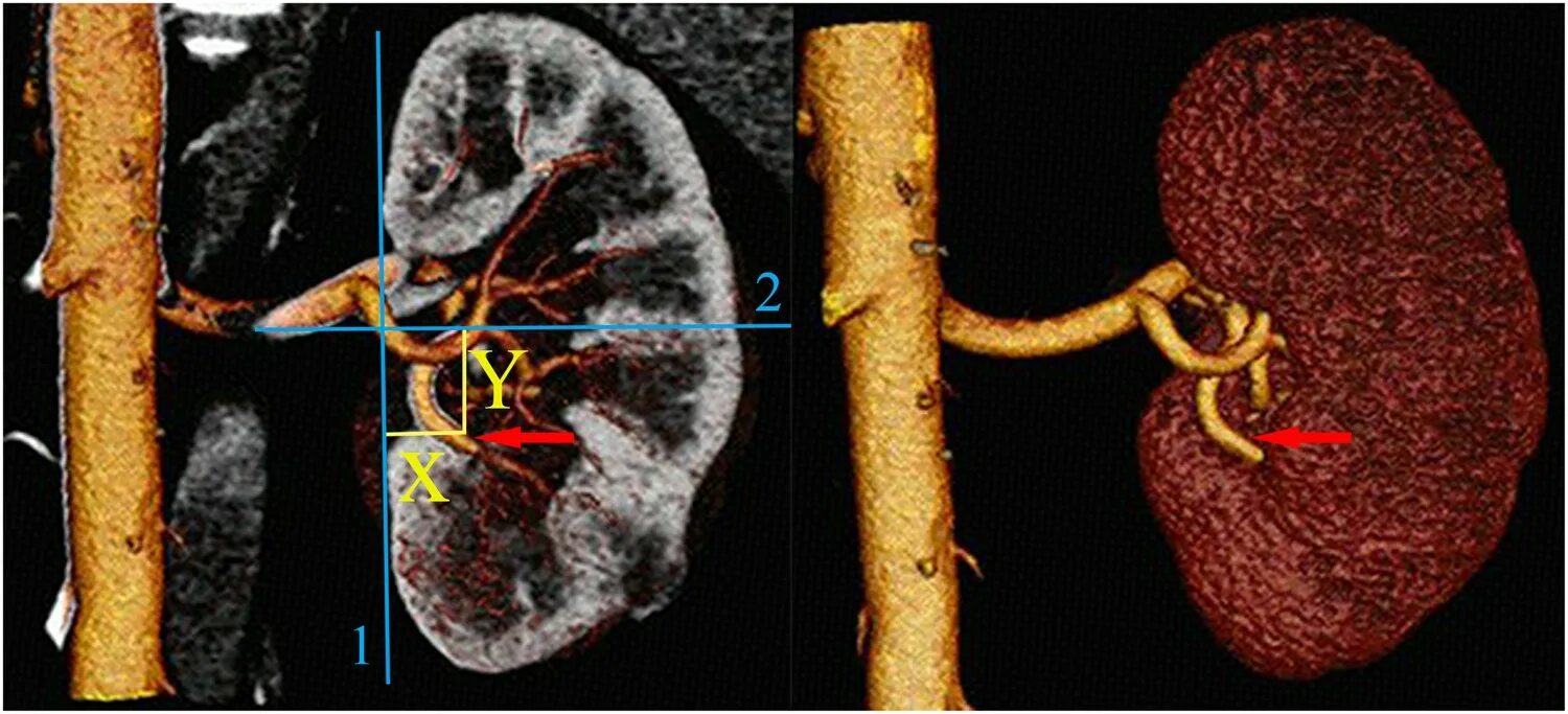 Нефрометрическая шкала renal. Renal почки. Двусторонний стеноз почечных артерий.