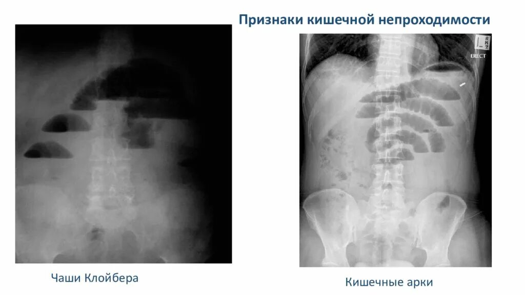 Симптом чаши. Кишечная непроходимость чаши клойбера. тонкокишечная непроходимость рентген. рентген брюшной полости чаши клойбера. кишечная непроходимость рентген чаши клойбера.
