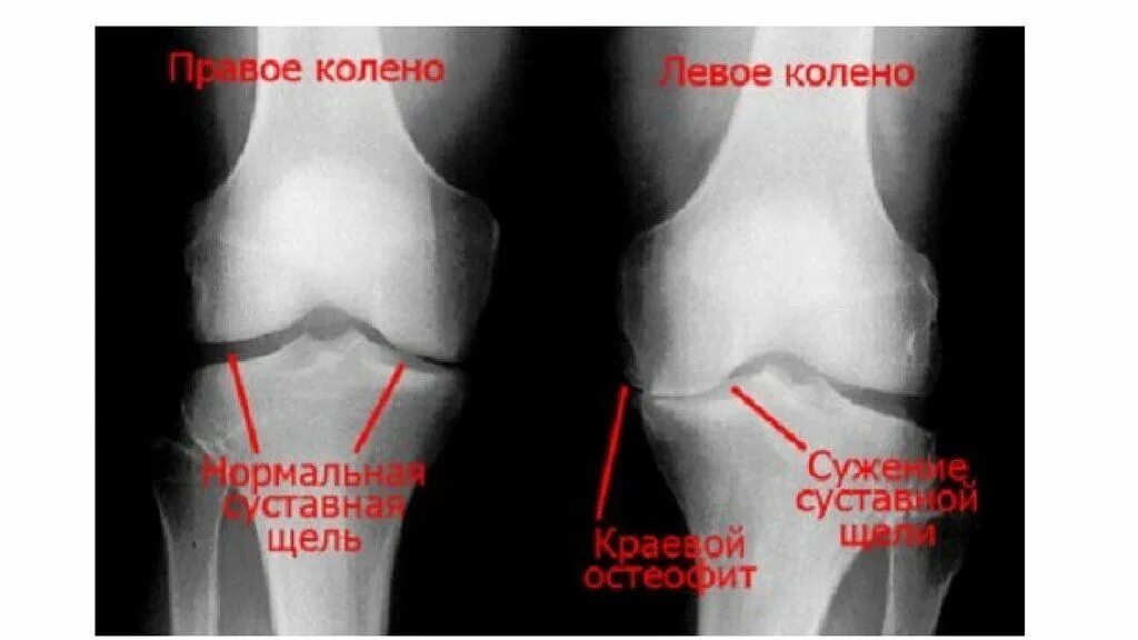 Коленный сустав по стадиям. Артрозо-артрит коленного сустава рентген. Деформирующий остеоартроз коленного сустава рентген. Остеоартроз остеофиты рентген колена. Гонартроз 2 стадии рентген.