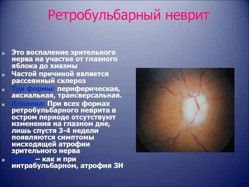 Клиника ретробульбарного неврита зрительного нерва. Ретробульбарный неврит глазное дно. Неврит зрительного нерва глазное дно. Ретробульбарный неврит (папиллит).
