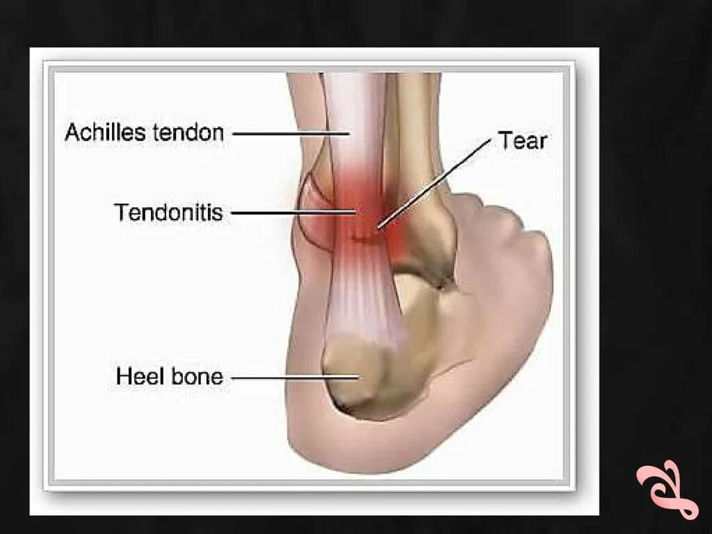 Почему болят сухожилия пятки. Иннервация ахиллова сухожилия. Ахиллово сухожилие пятки. Пяточное ахиллово сухожилие.