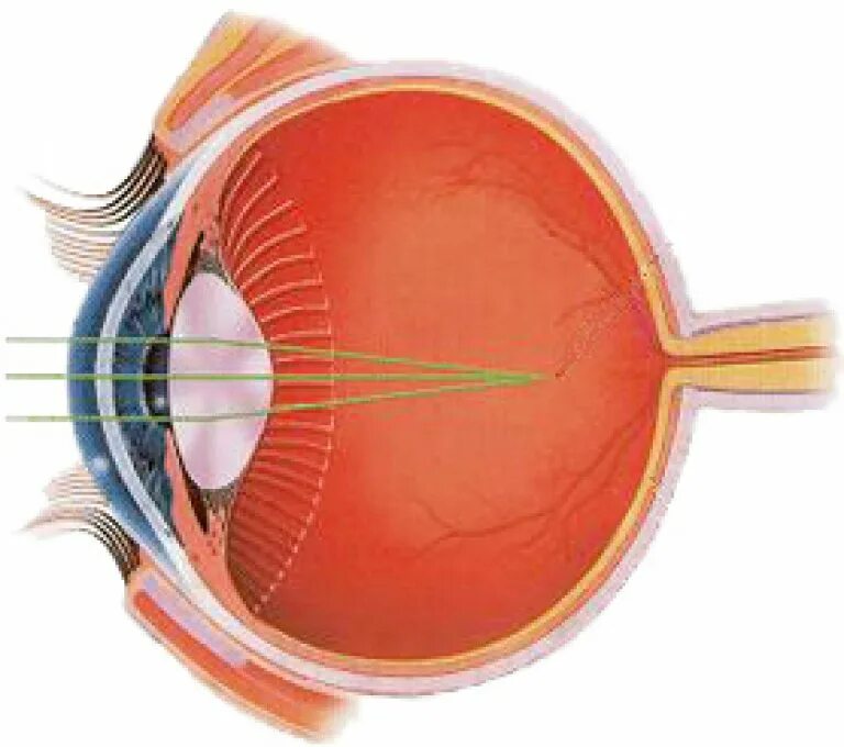 Близорукость глазное яблоко. Форма глазного яблока. Вытянутое глазное яблоко. Лучи света фокусируются за сетчаткой