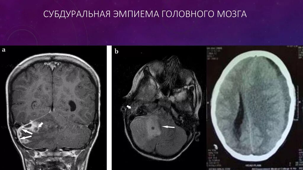 Субдуральный абсцесс кт. Субдуральная эмпиема кт. Эмпиема головного мозга мрт. Субдуральный абсцесс мрт. Гематома мозга операция