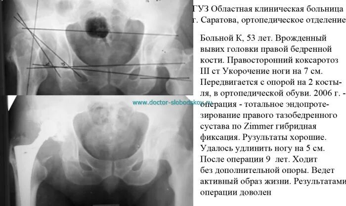 Операция тазобедренная замена сколько длится. Тазобедренного эндопротеза операция. Больничный лист при эндопротезировании тазобедренного сустава. Срок больничного после эндопротезирования тазобедренного сустава. Нетрудоспособность после эндопротезирования тазобедренного сустава.