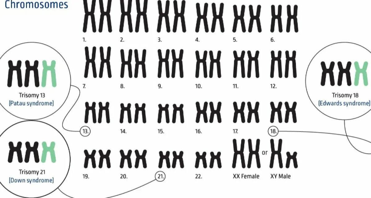 Синдром Дауна кариотип. Набор хромосом при синдроме Дауна. Кариотип синдрома Дауна транслокация. Синдром Дауна трисомия 21 хромосомы.