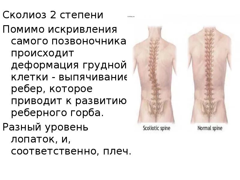 Сколиоз 2 степени это. Степени искривления сколиоза. Фиксированный сколиоз II степени. Сколиоз поясничного отдела позвоночника рентген степени. Сколиоз позвоночника 2.