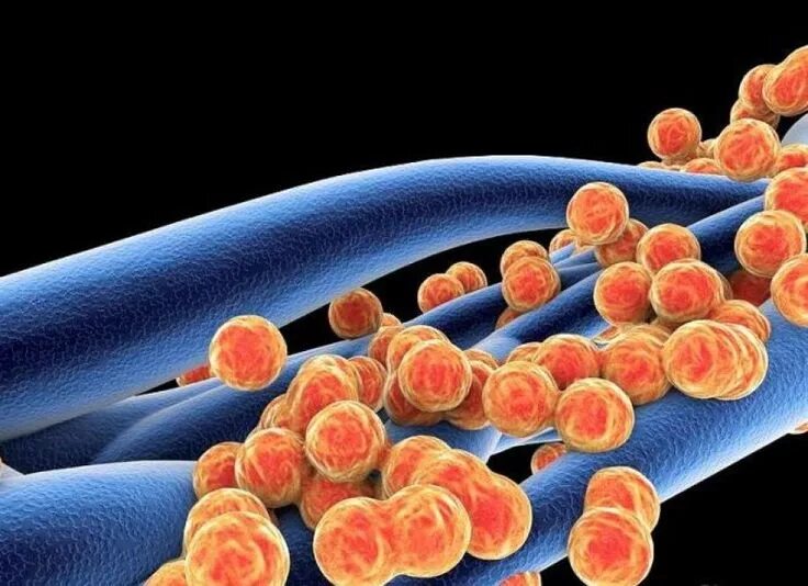 Staphylococcus aureus в носу. Метициллин-резистентный золотистый стафилококк. Стафилококк тонзиллит. Метициллин резистентный.