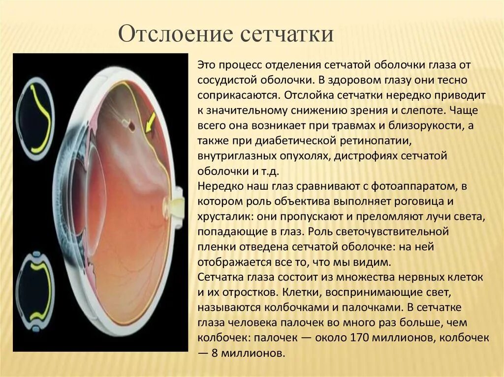 Отслойка сетчатки глаза симптомы. Назовите основные методы лечения отслойки сетчатки.. Отслойка сетчатки причины.