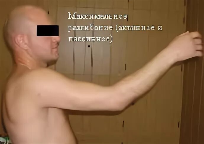 лечебная физкультура после перелома плеча. контрактура локтевого сустава после перелома. сгибательная контрактура локтевого сустава. контрактура локтевого сустава лечение. операция при контрактуре локтевого сустава.