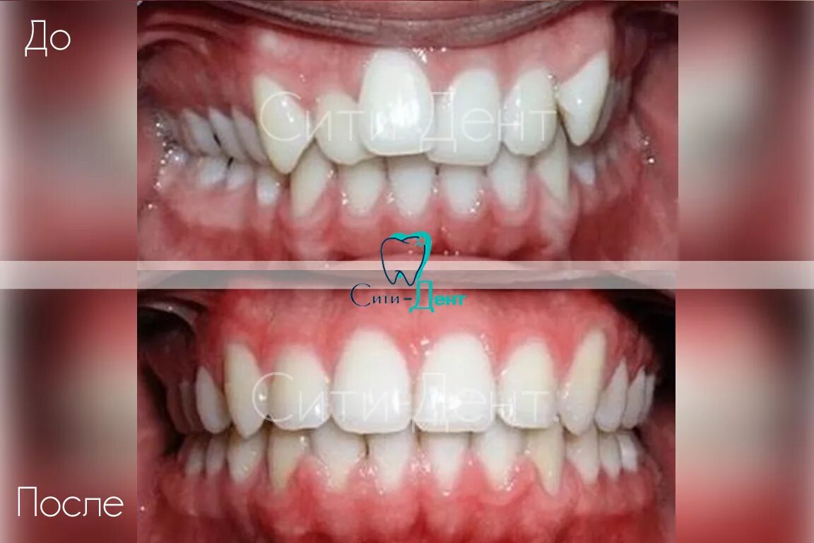 Перекрестный прикус элайнерами. Глубокий прикус до и после брекетов. Элайнеры на зубах фото реальные. Элайнеры для зубов до и после. Исправление прикуса брекетами до и после.