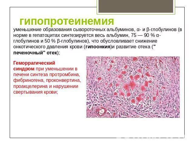 Общий белок низкий причины. Снижение общего белка и альбуминов. Снижение уровня альбумина. Снижение белка и альбумина в крови. Снижение общего белка и альбумина в крови.