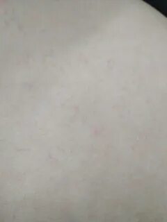 Аллергия на амоксиклав