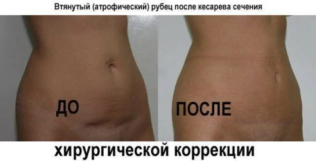 Пластика после кесарева сечения. Лазерная шлифовка рубца на животе. рубец после кесарево сечения на животе. шлифовка шрама после кесарева.