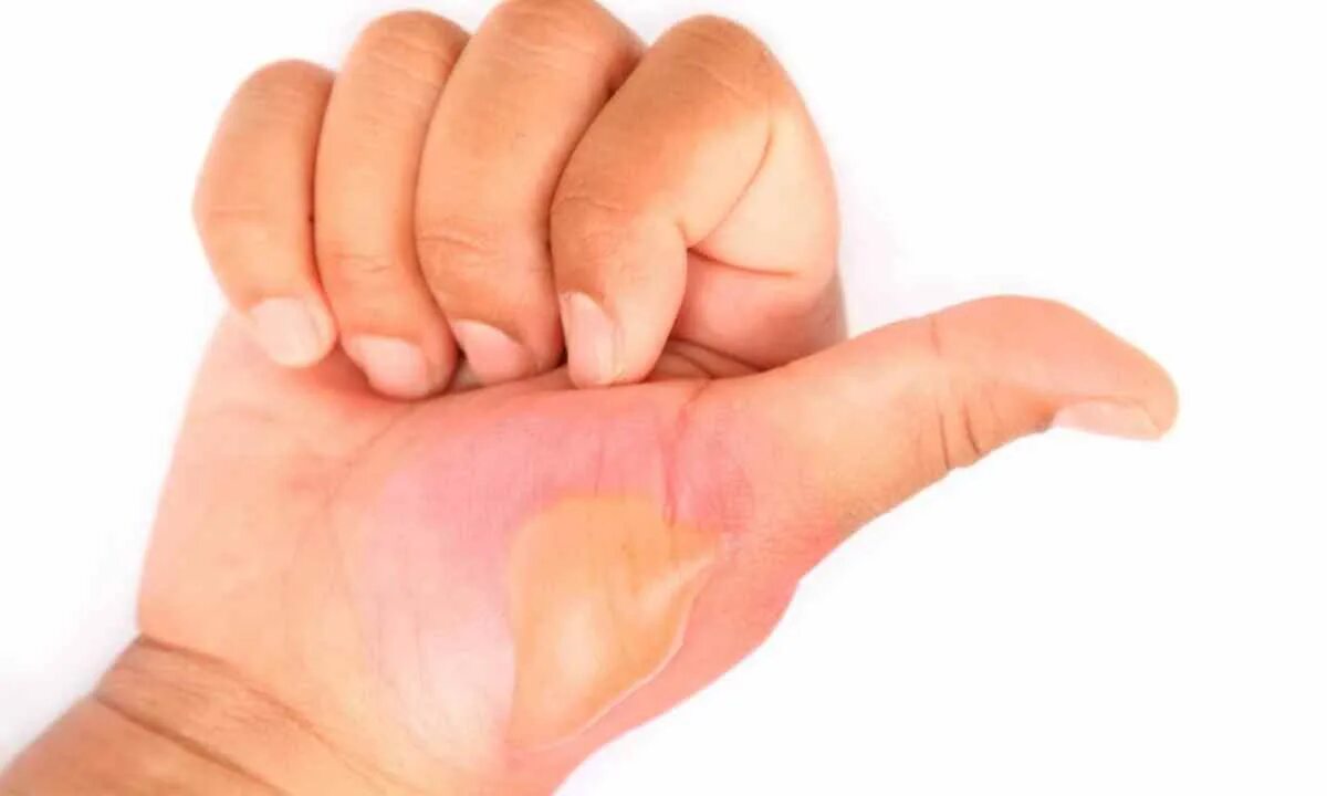 Burned hand