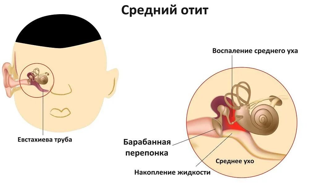 Острый Гнойный отит антибиотики. Антибиотики от среднего отита у ребенка. Острый средний отит ушные капли. Воспаление среднего уха.