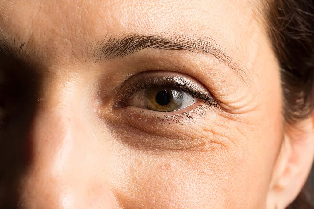Морщины под глазами. Морщины у глаз. Морщины в 30 лет фото. Мелкие мимические морщины. Skin wrinkles