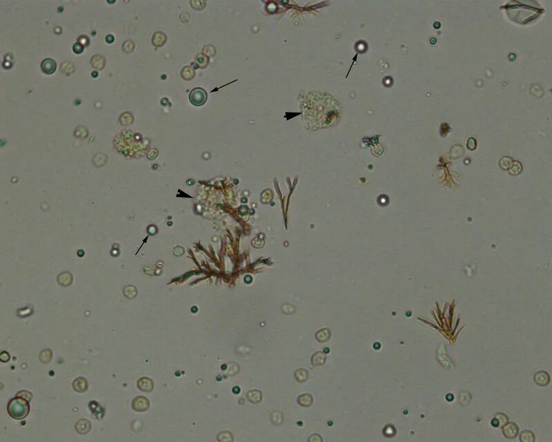 Иглы в моче. Кристаллы билирубина в моче под микроскопом. Билирубин в моче микроскопия. Микроскопия мочи билирубин. Билирубин в моче под микроскопом.